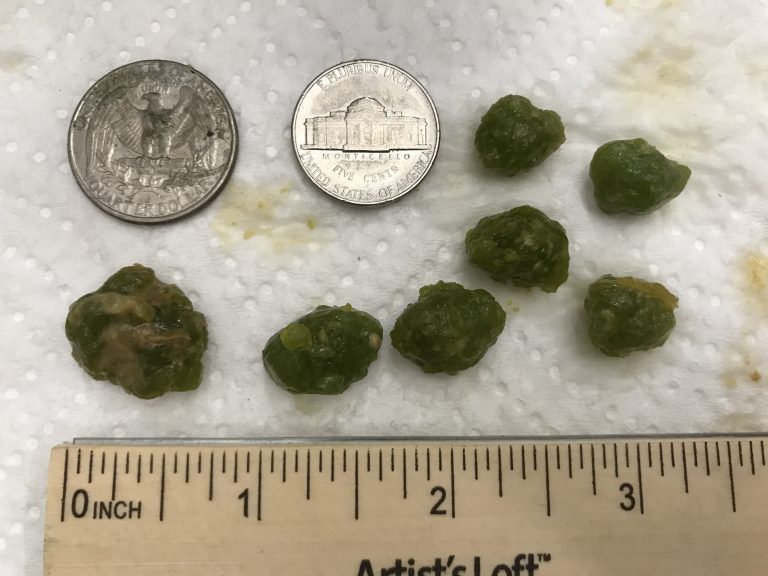 Gallbladder Stones Herbal Education Center gallbladder-stones-herbal-education-center